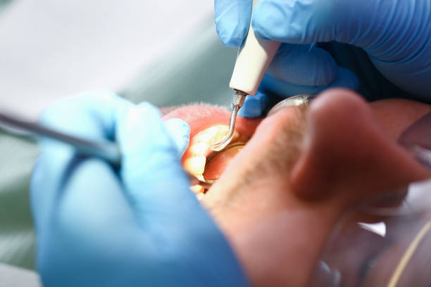 Best Chipped Tooth Repair Near Me  in Wellington, TX